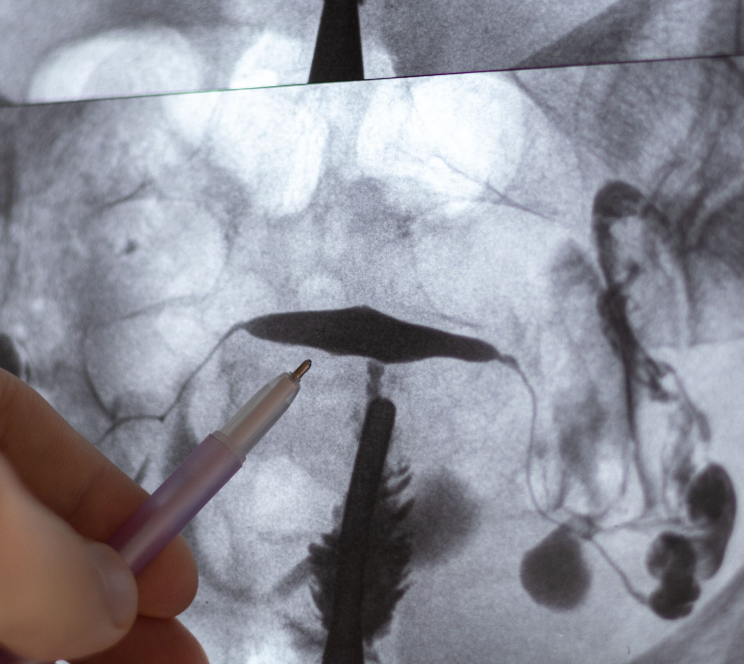 Radiographie pelvienne avec un stylo pointant vers la radiographie - hysterosalpingographie| Imagerie Cardinet | Région Parisienne