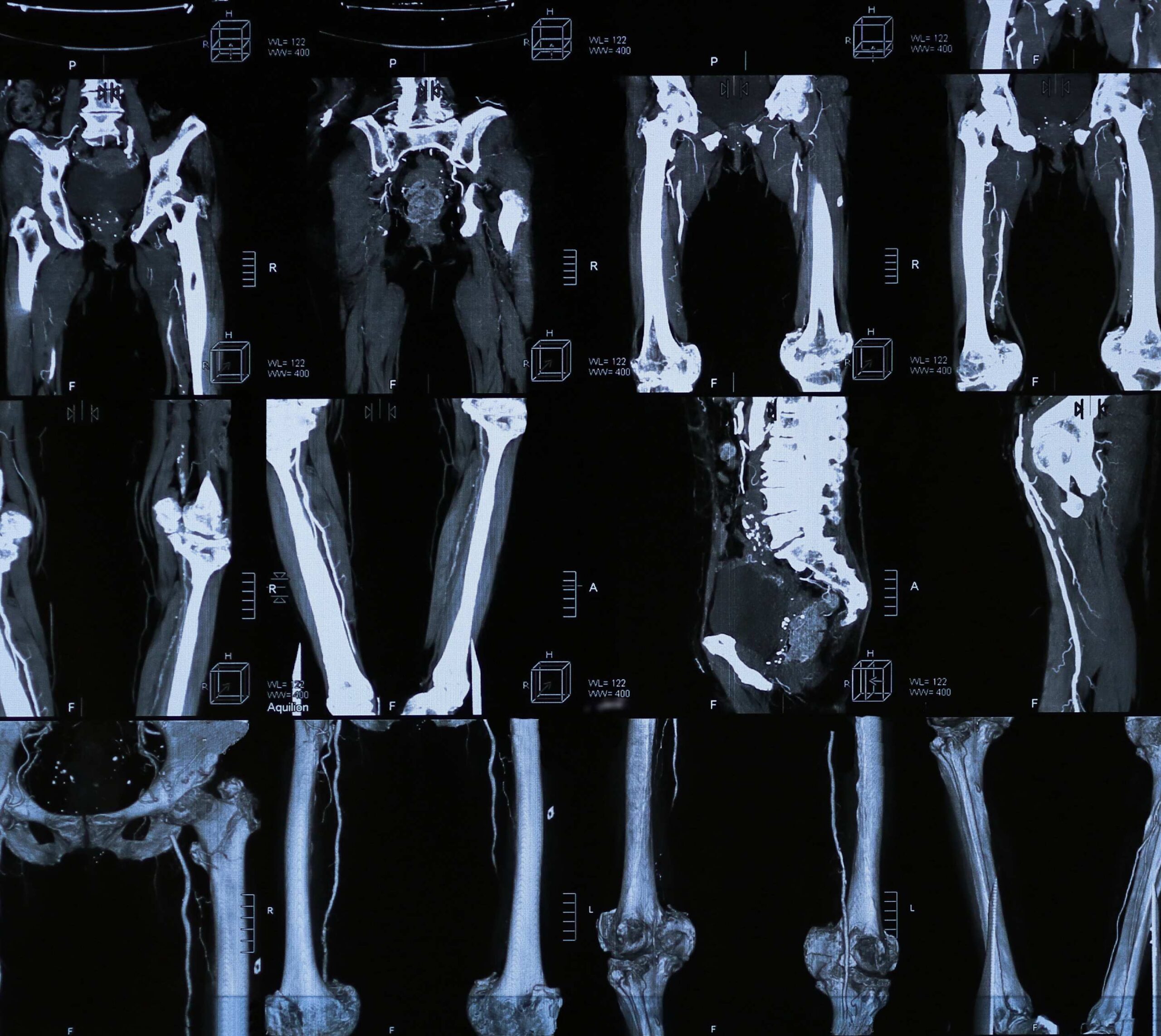 Image montrant des radiographies médicales des os du bassin et des jambes| Imagerie Cardinet | Région Parisienne