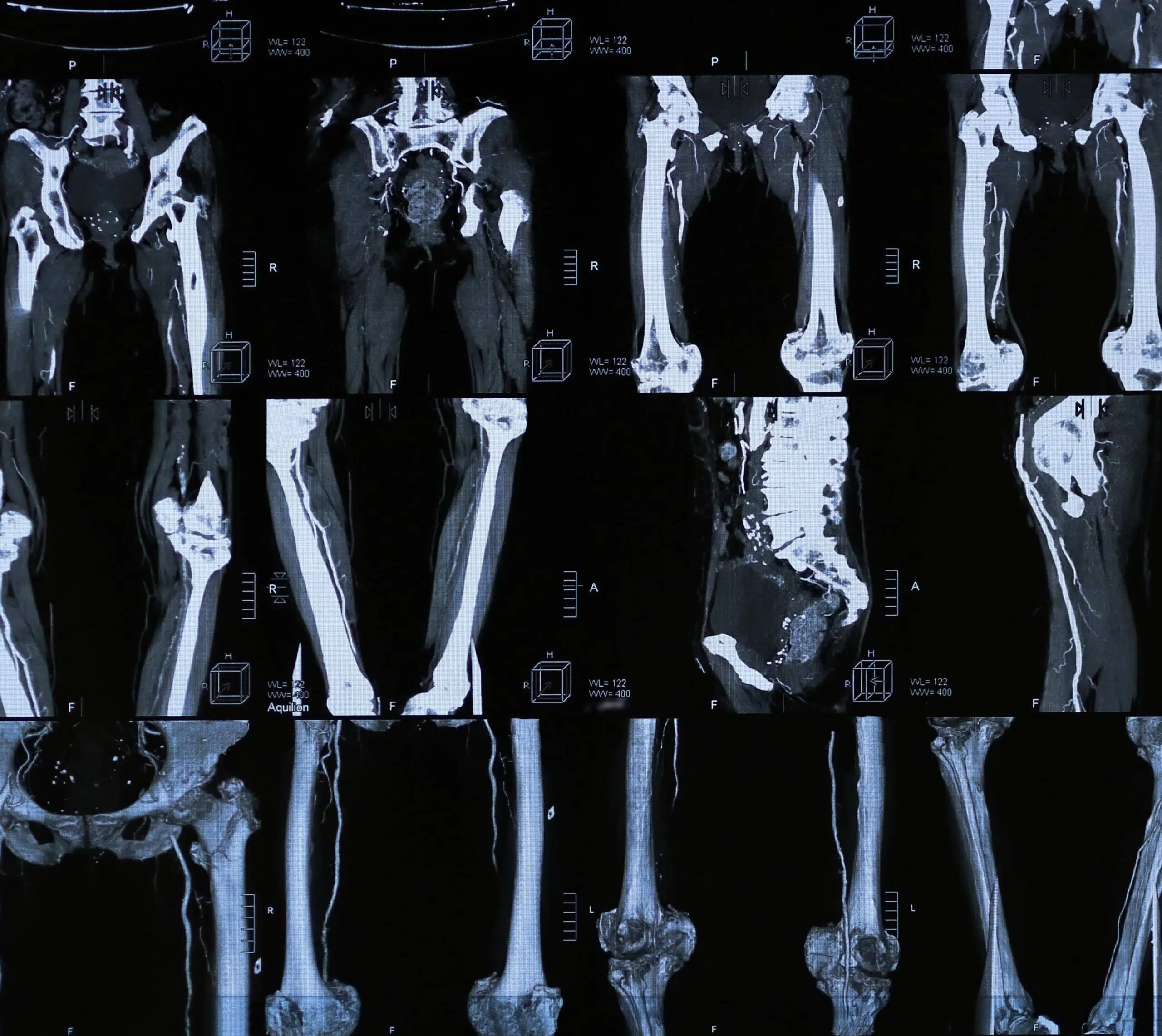 Image montrant des radiographies médicales des os du bassin et des jambes| Imagerie Cardinet | Région Parisienne