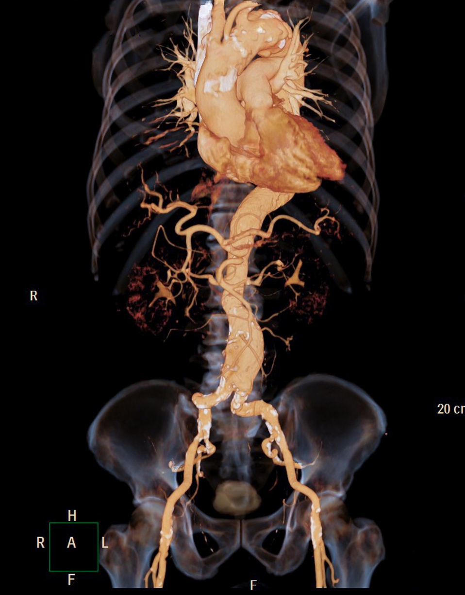 Angiographie montrant les artères principales du tronc et des jambes -angioscanner | Imagerie Cardinet | Région Parisienne