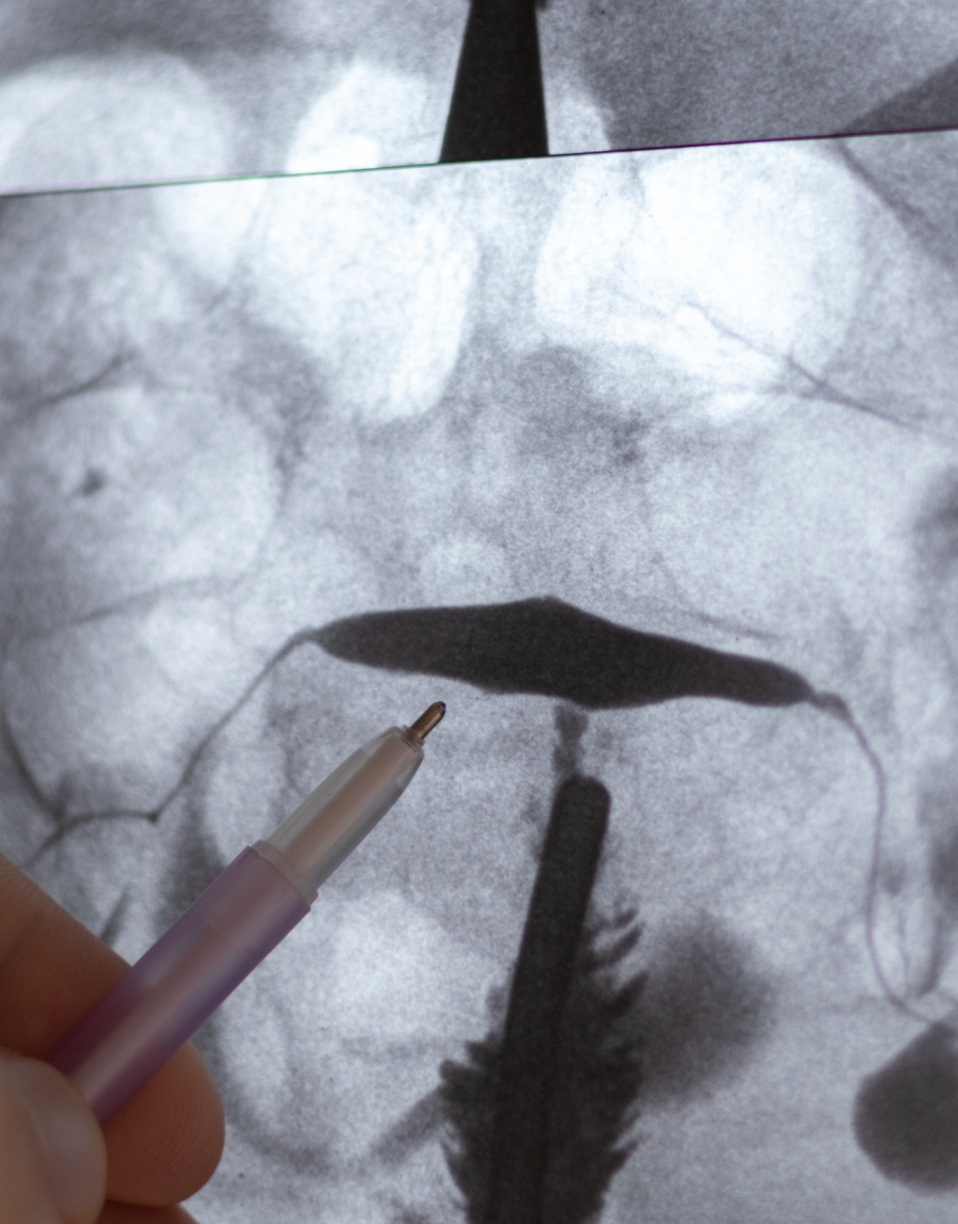 Radiographie avec un dispositif médical inséré | Imagerie Cardinet | Région Parisienne