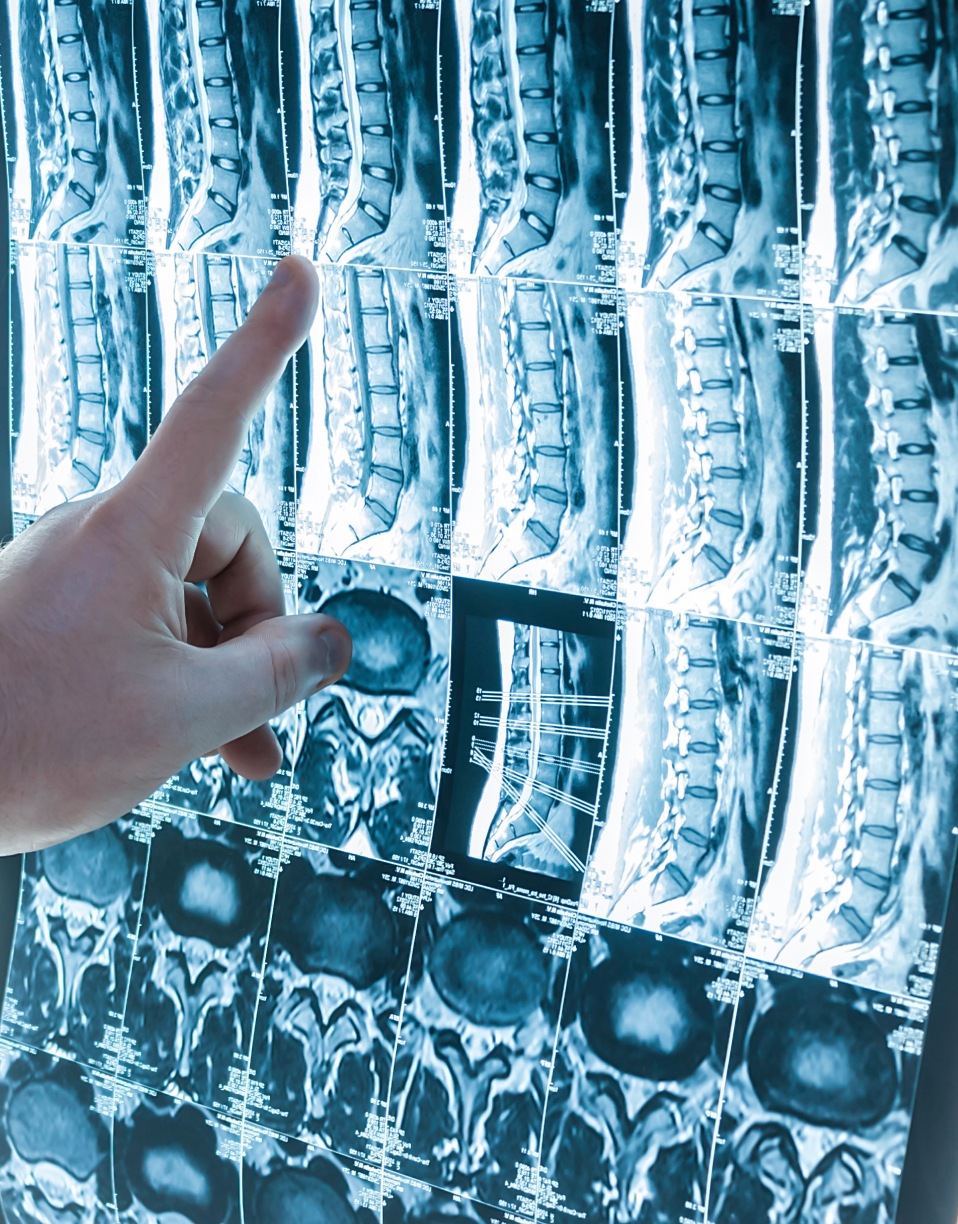 Doigt pointe vers une radiographie de la colonne vertébrale sur un écran lumineux - IRM rachidienne| Imagerie Cardinet | Région Parisienne