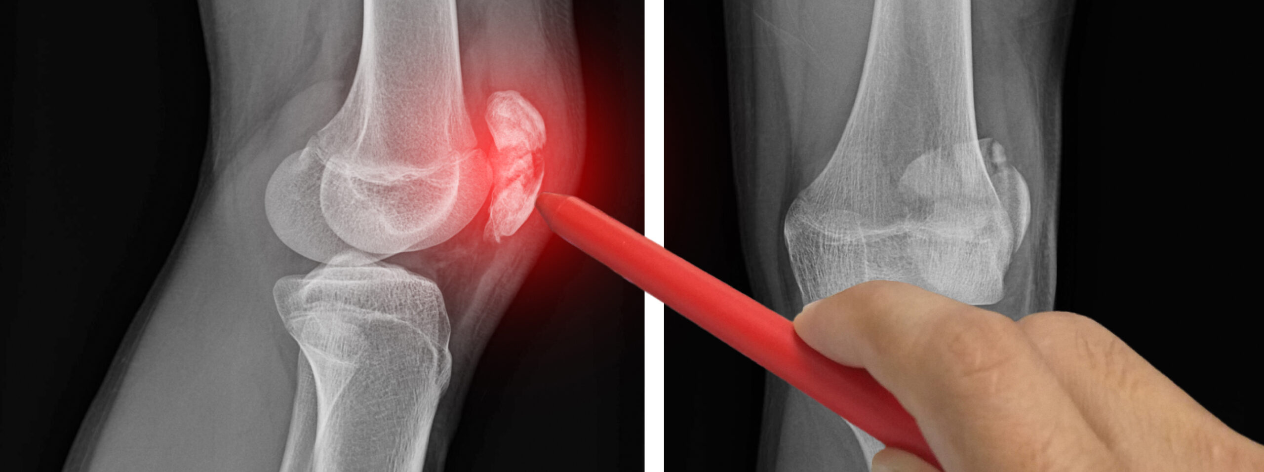 infiltration articulaire