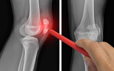 infiltration articulaire