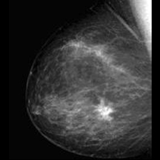 Mamographie